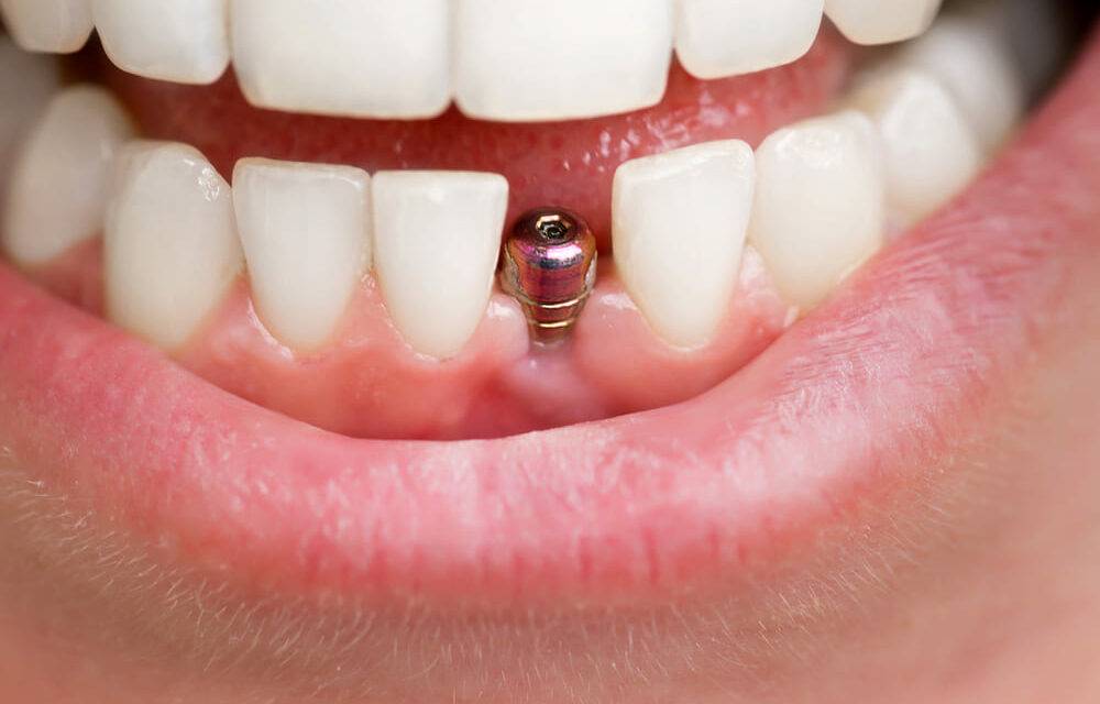 Dental Implants 101: What They Are and How They Can Benefit You